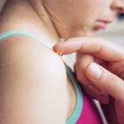 Creme auf Masern auftragen Creme auf Masern auftragen